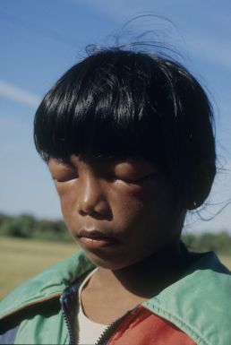 Portugal: Hiranti after being stung by bees
